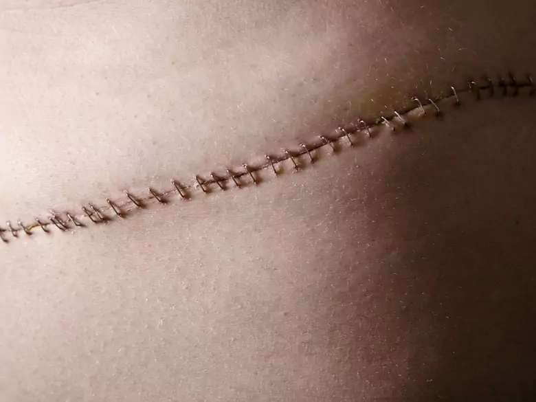 Crèmes pour cicatrices - sont-elles sûres et efficaces ?