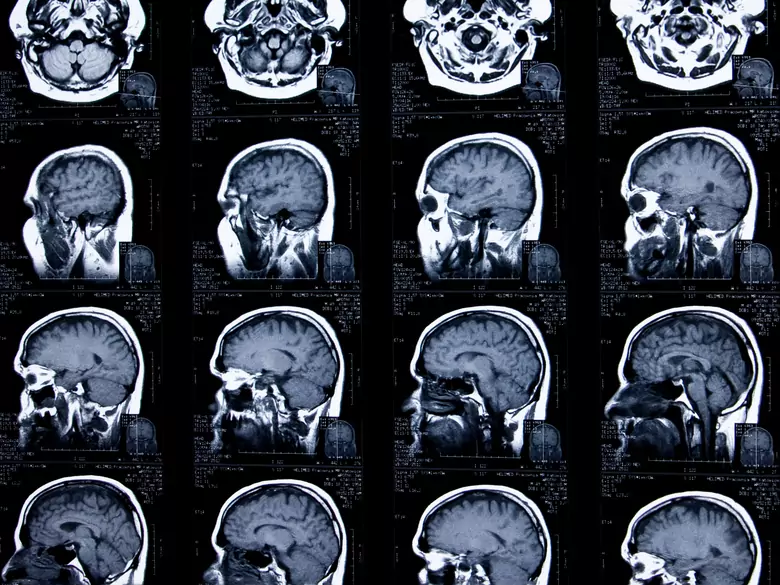 Kyste pinéal - causes, symptômes, diagnostic, traitement