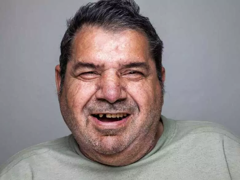 Pourquoi l'obésité peut-elle augmenter le risque de maladie parodontale ?