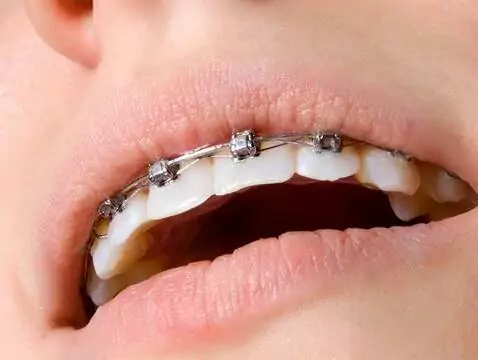 Diagnostic de la malocclusion