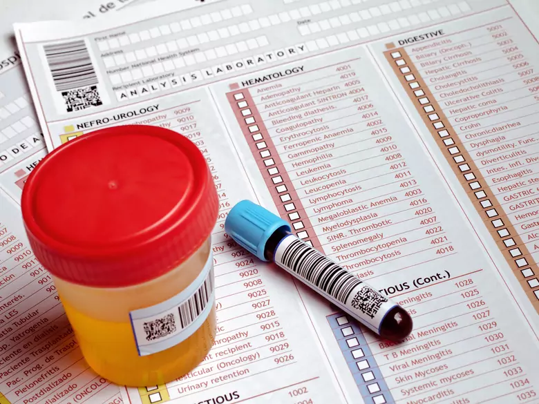 Odeur d'urine inhabituelle et diverses maladies