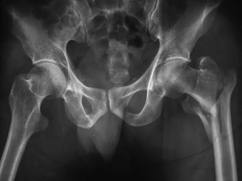 Fragilité osseuse chez les femmes périménopausées et postménopausées - causes, symptômes, diagnostic, traitement