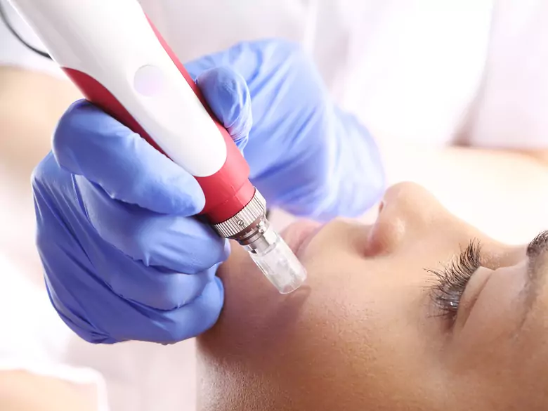 Traitement de l'acné - thérapie au laser