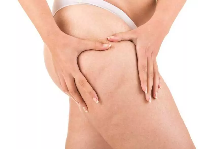 Lipodémie - maladie des "jambes grasses