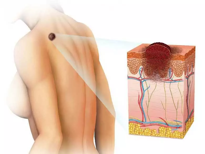 Cancer de la peau et affections précancéreuses