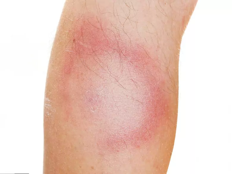 Qu'est-ce que le lupus ?