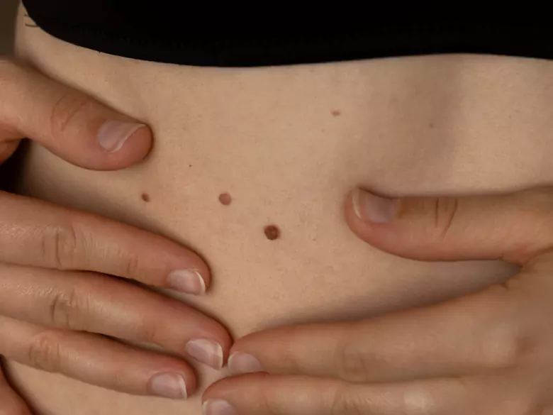 Lésions cutanées - quand consulter un dermatologue ?