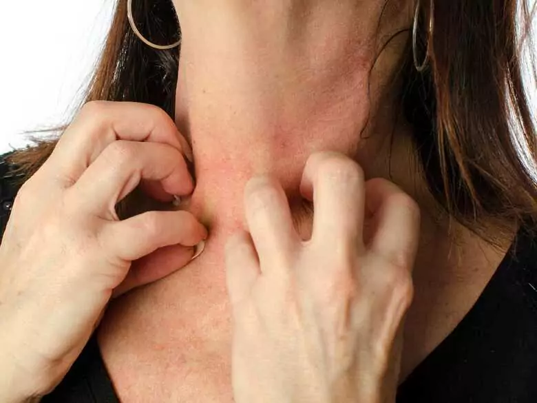 Épidémiologie de l'allergie de contact au nickel