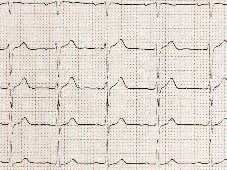 Diagnostic par des tests ECG