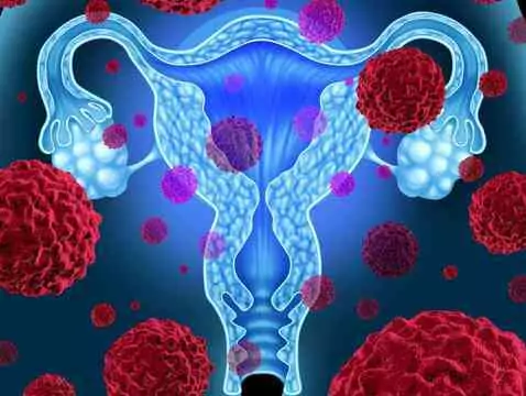 Virus HPV et cancer de l'ovaire : le pathogène favorise-t-il le cancer ?