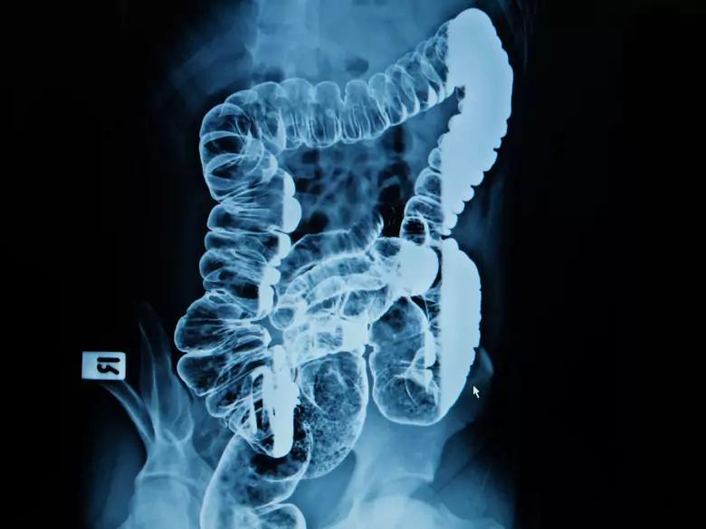 Cancer colorectal - causes, symptômes, diagnostic, traitement