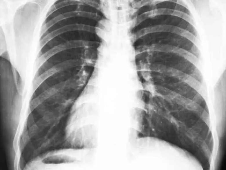 Douleur thoracique d'origine cardiaque - causes, symptômes, diagnostic, traitement