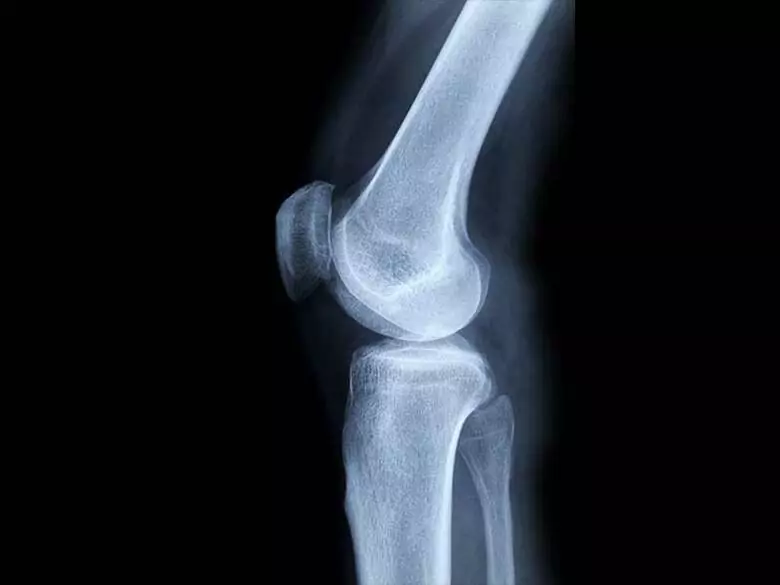 Tumeur osseuse maligne - causes et facteurs de risque