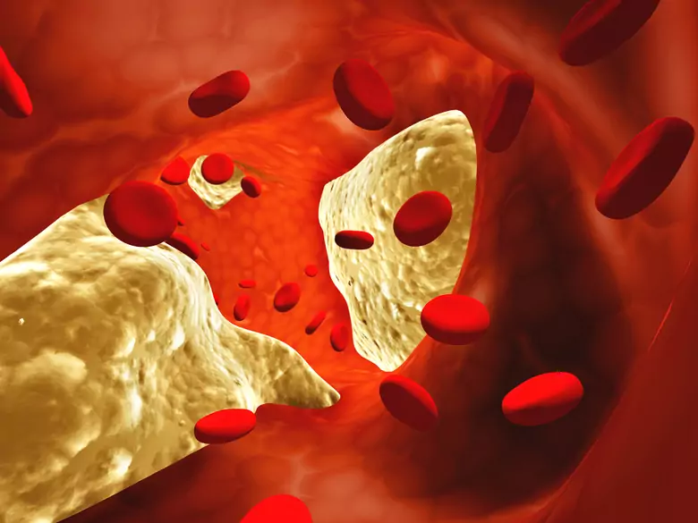 Tout ce que vous devez savoir sur les statines