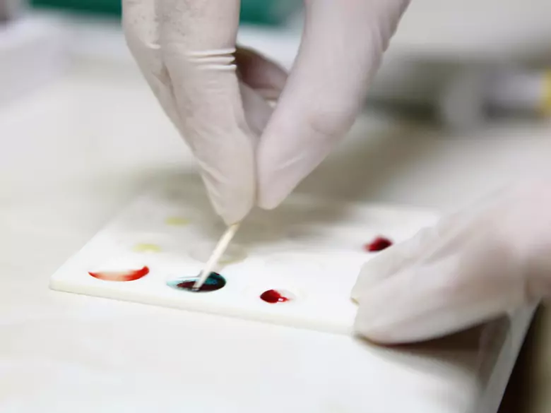 Frottis de sang périphérique - réduction du nombre de lymphocytes