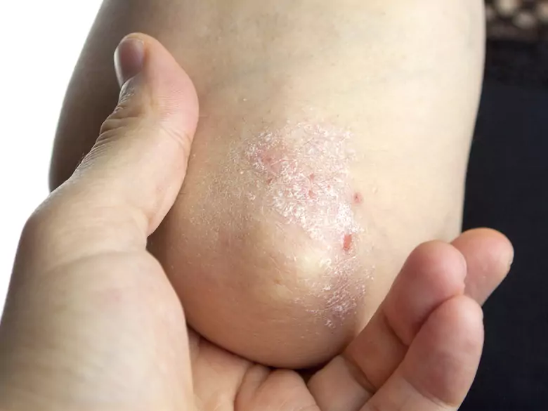 Une pommade utilisée par les personnes souffrant de psoriasis va disparaître des rayons des pharmacies !