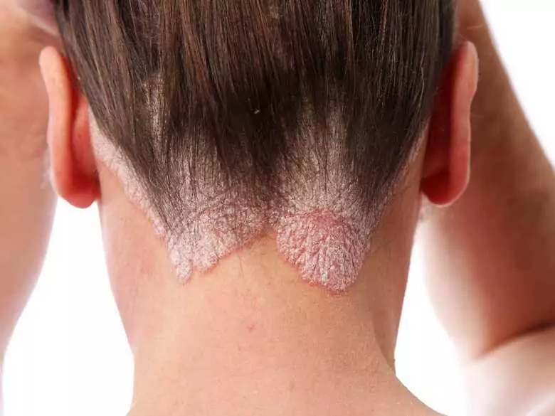 Signification de l'allèle LHA - Cw6 dans le psoriasis