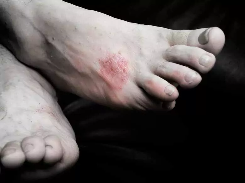 Rhumatisme psoriasique et maladies cardiovasculaires