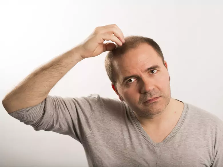 Qu'est-ce que l'alopécie et comment est-elle traitée ?