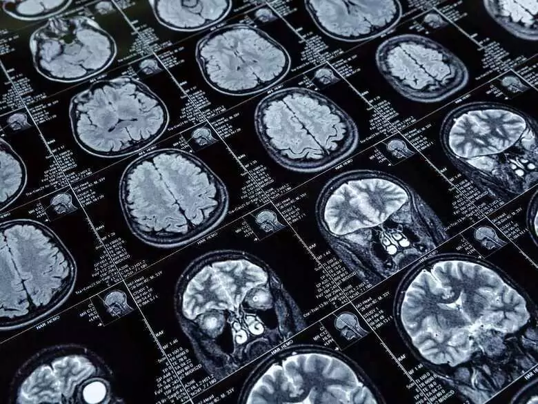 Les séquelles les plus fréquentes de l'accident vasculaire cérébral ischémique