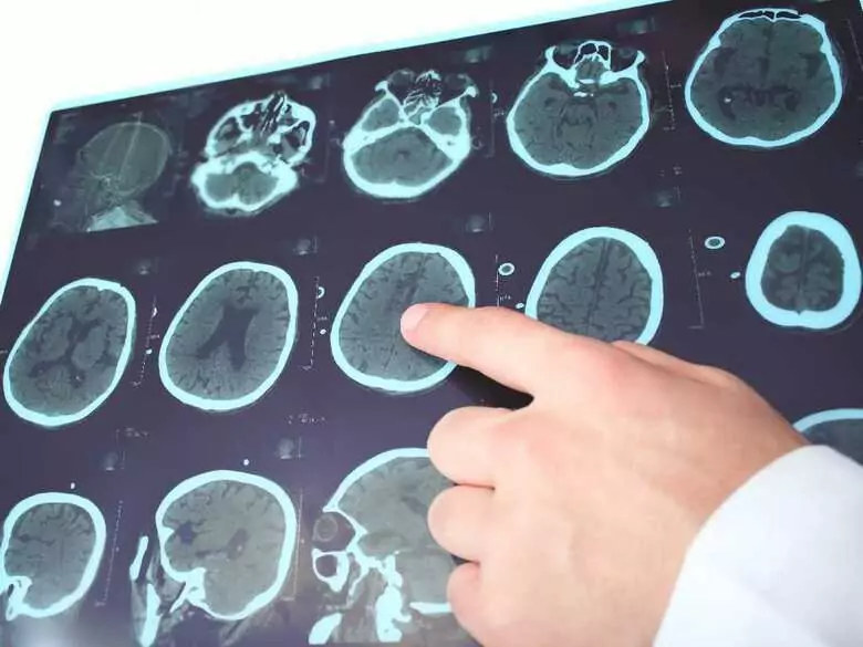 Les paraplégies spastiques - qu'est-ce que c'est ?