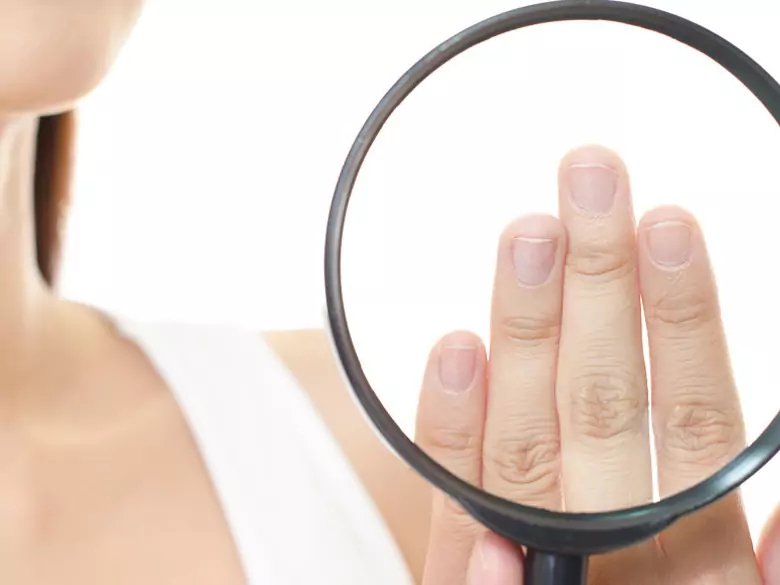 Quels sont les remèdes les plus efficaces contre la mycose des ongles ?