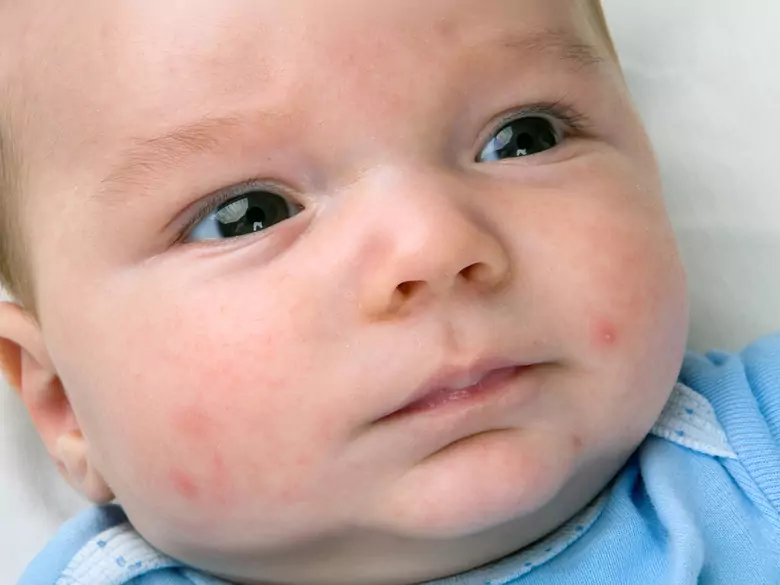 Allergie alimentaire ou éruption cutanée - que doivent savoir les parents ?