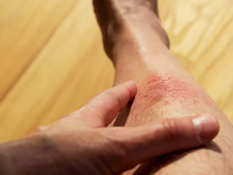 La pemphigoïde bulleuse peut-elle être mortelle ?