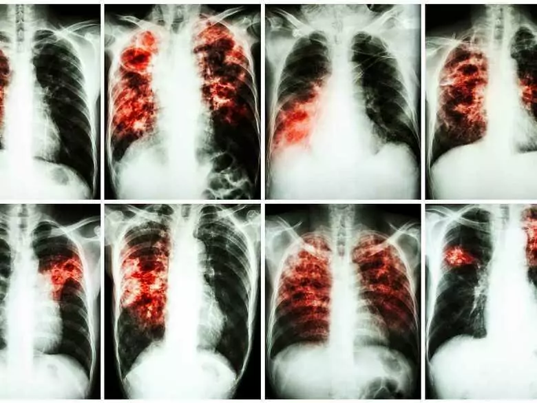 Des scientifiques tchèques ont inventé un nouveau médicament contre la tuberculose