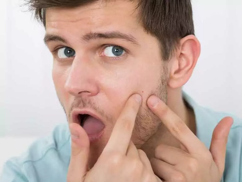 Acné chez l'adulte : pourquoi de plus en plus de trentenaires sont-ils aux prises avec des lésions cutanées ?