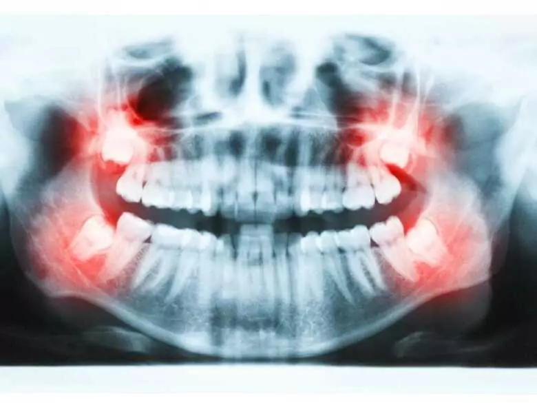 La robotique dans le traitement des dents cassées