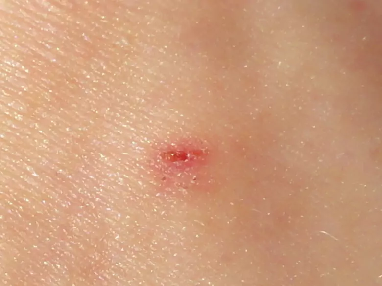 Le contrôle régulier des naevus peut sauver des vies