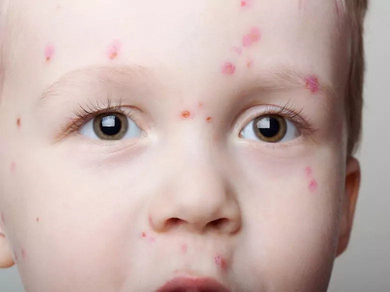 Le savon peut-il être allergisant ?