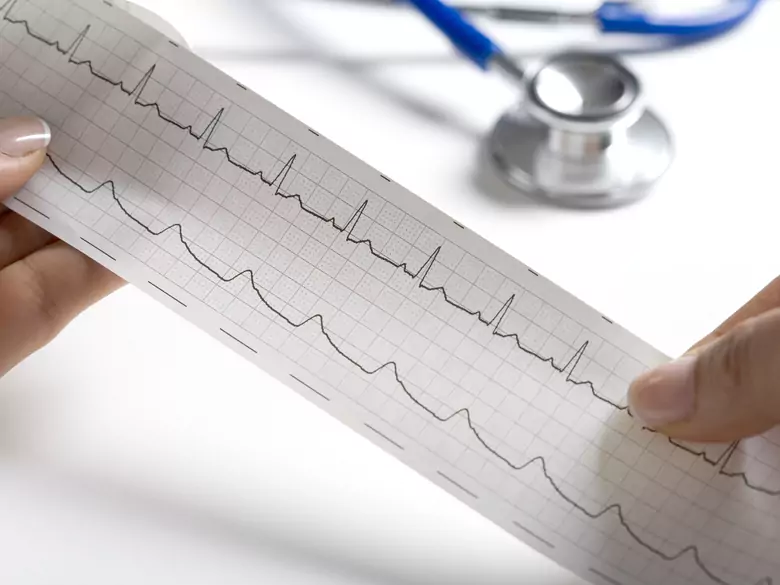 Insuffisance cardiaque