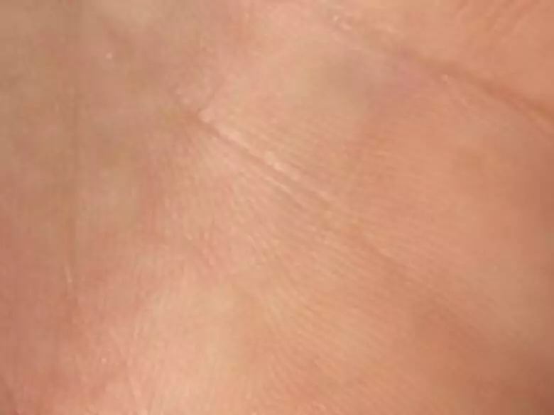 Naevus vasculaire plat