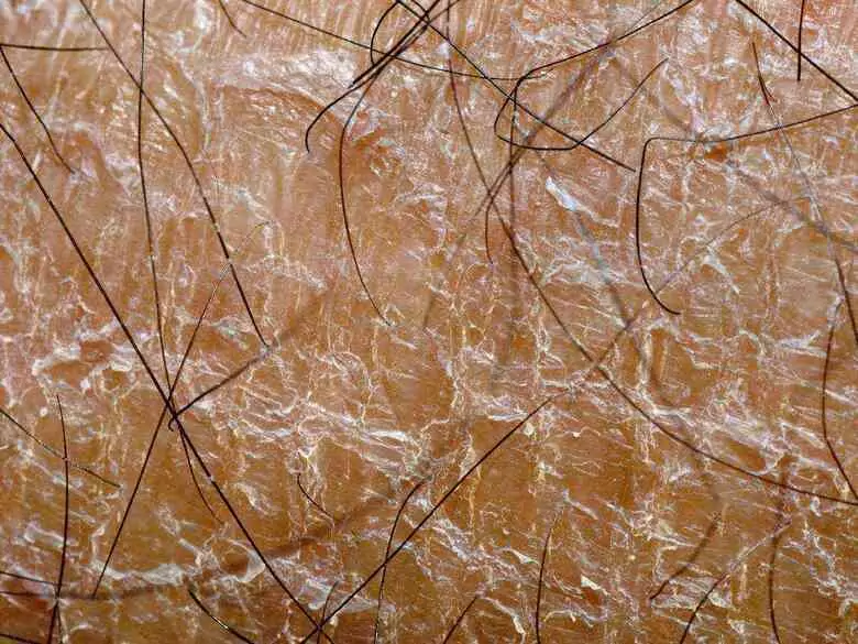 Comment traiter les problèmes de séborrhée ?