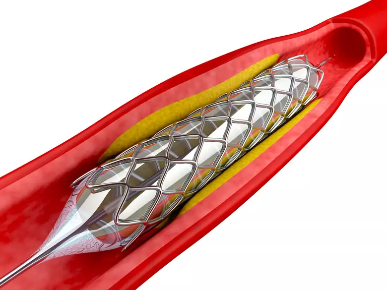 Anévrisme de l'aorte - causes, symptômes, diagnostic, traitement