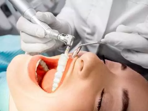 Vernissage des dents