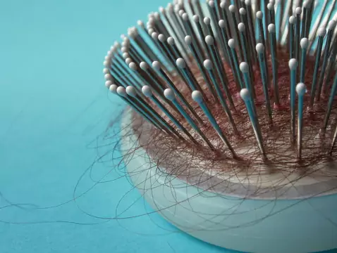 Perte de cheveux - causes, symptômes, diagnostic, traitement