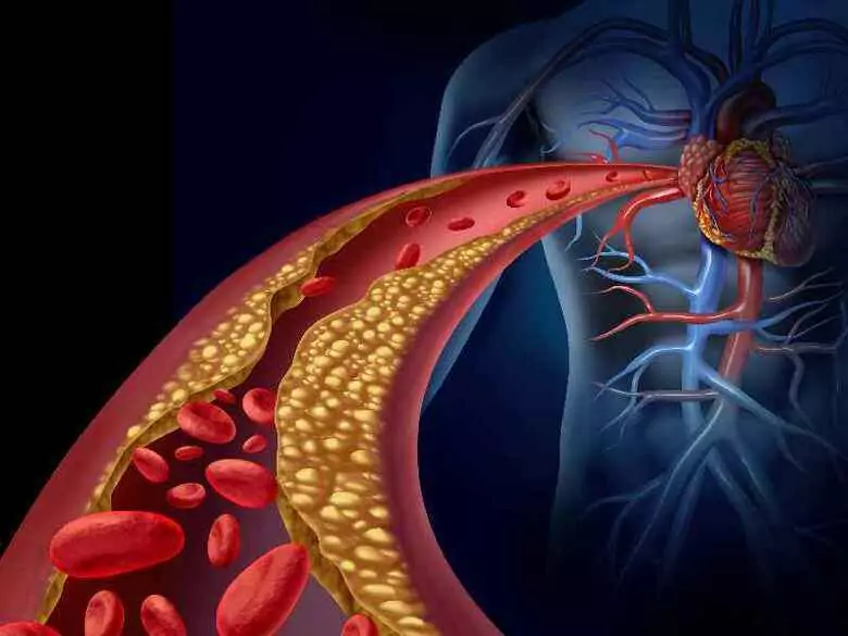 Sténose de l'artère sous-clavière