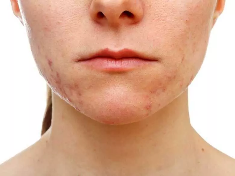 Acné et port de masque : y a-t-il une corrélation ?