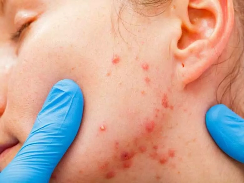 Acné : quand consulter un dermatologue ?