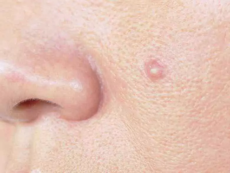 Formes atypiques de rosacée