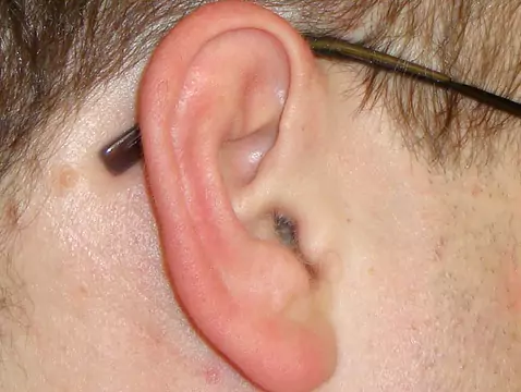 Troubles de la ventilation et de l'écoulement de l'oreille moyenne - causes, symptômes, diagnostic, traitement