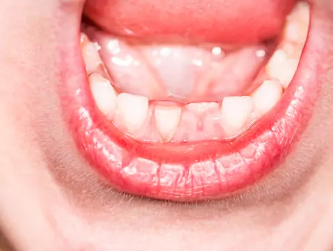 Stomatite fongique - causes, symptômes, diagnostic, traitement