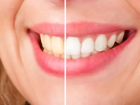 Blanchiment des dents au laser - l'essentiel de la procédure ?