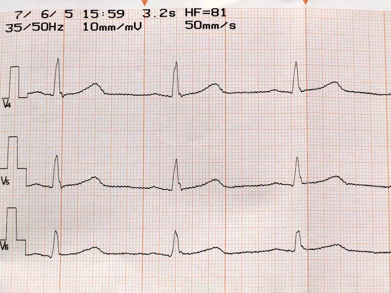 Troubles du rythme cardiaque - causes, symptômes, diagnostic, traitement