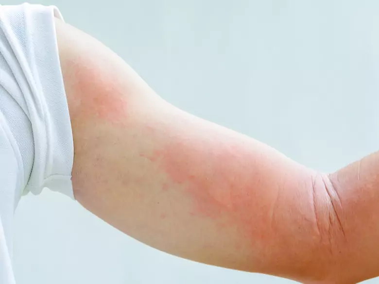 Paralysie nerveuse après une hémiplégie - le pronostic vital est-il engagé ? 