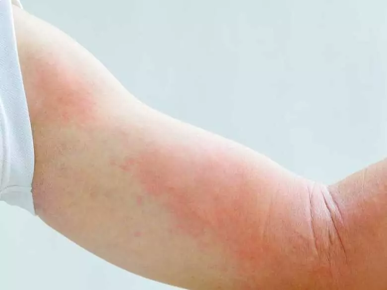 Comment traiter l'eczéma ?