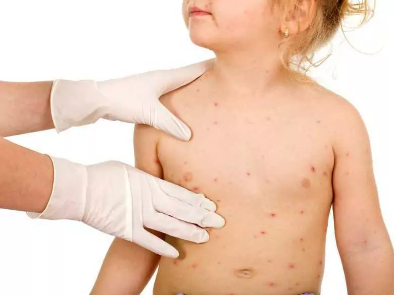 Remèdes maison pour soulager les symptômes de la varicelle